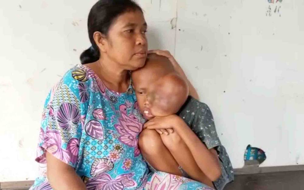 Marvel Jhonfratola (12) harus melawan penyakit tumor sejak 2018 di tengah keterbatasan keluarganya. (Istimewa)