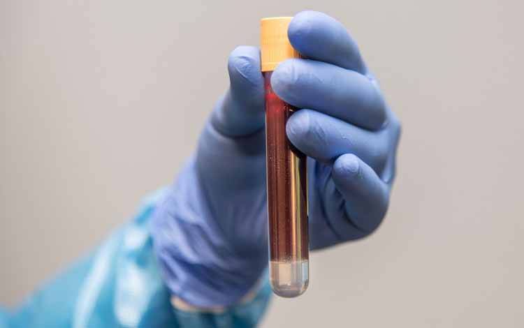 Anda Harus Sehat Bila Ingin Jadi Pendonor Plasma Konvalesen