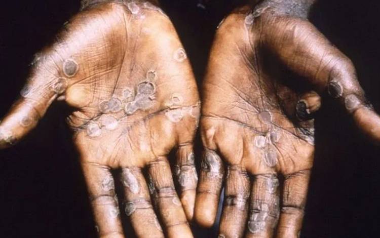 Sembilan kasus dicurigai Cacar Monyet, Kemenkes: tidak terbukti "Monkeypox"