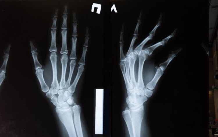 Dokter: Perempuan di Atas 50 Tahun Lebih Rentan Terkena Osteoporosis