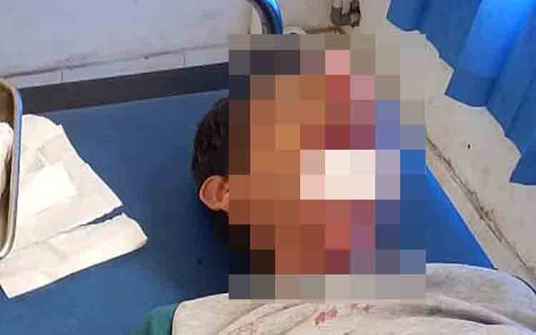 Tabrakan Antar Motor Matic di Tamiang Layang, Satu Korban Luka Parah di Wajah