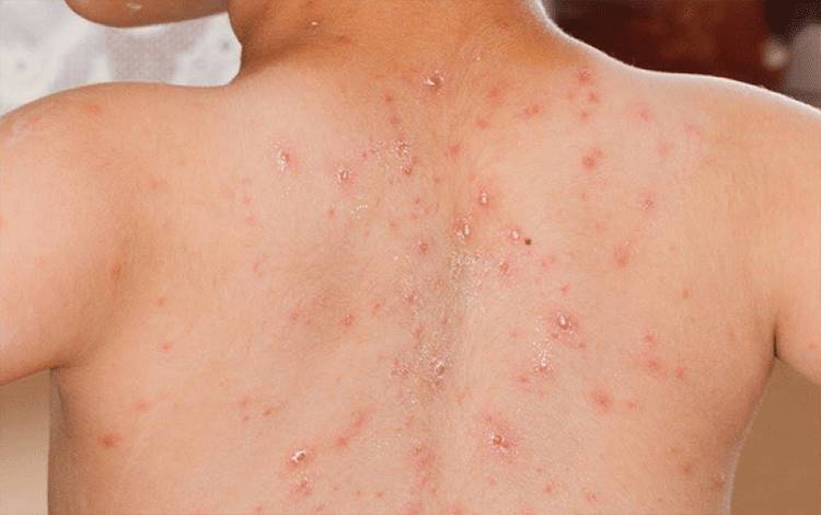 Virus Campak Dapat Menular Dengan Cepat, Perlukah Lakukan Isolasi?