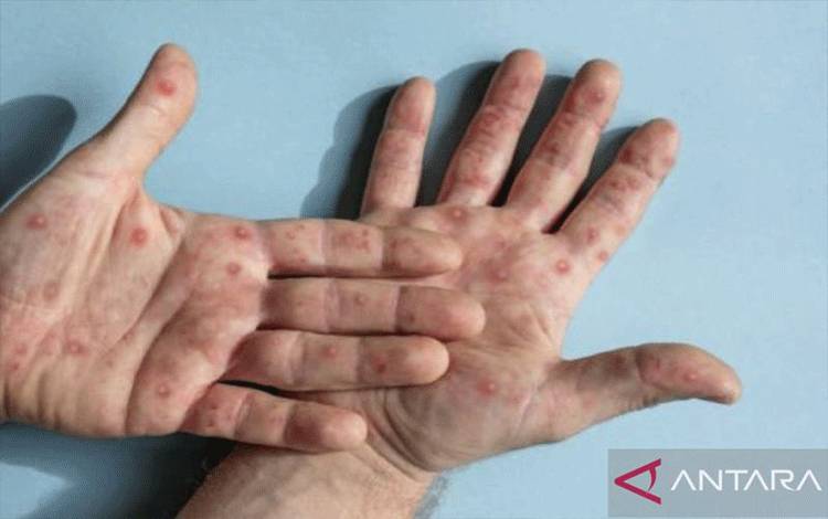 WHO: RD Kongo Laporkan Kasus Mpox Tertinggi Sejak 2020