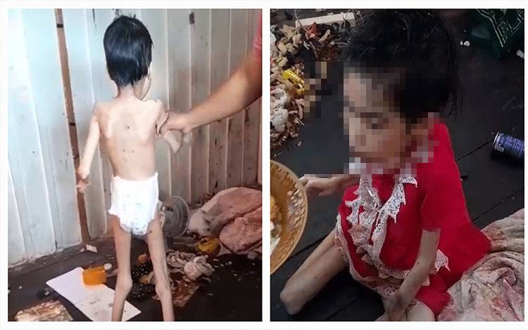 Memprihatinkan, Bocah Berusia 14 Tahun di Kobar Hanya Miliki Bobot 12 Kg