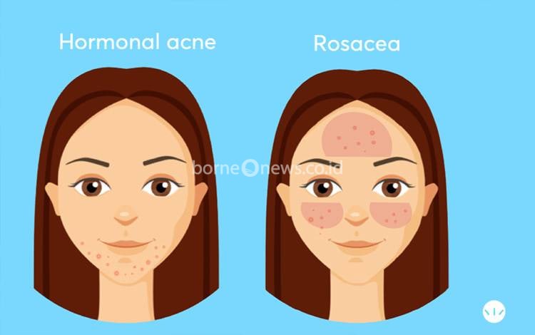 Mengenal Rosasea Lebih Dekat