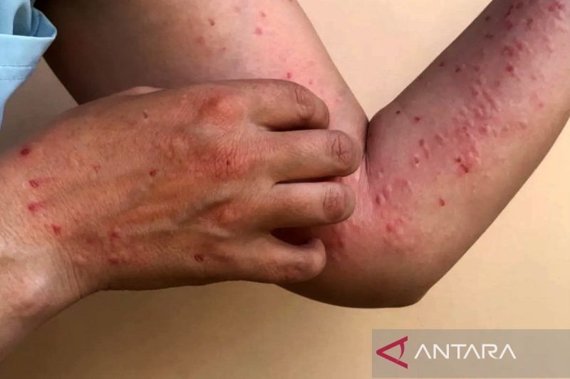 Ilustrasi - Cacar monyet atau Mpox. ANTARA/Shutterstock/am