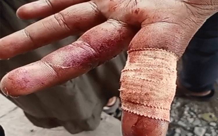 Pengendara Motor di Kapuas Terluka Akibat Benang Layang-Layang