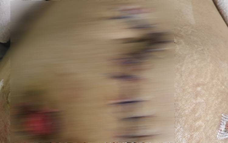 Dugaan Malapraktik di RSUD Doris Sylvanus Palangka Raya, LBH PHRI Dampingi Pasien Alami Komplikasi Berat Pasca Operasi Caesar